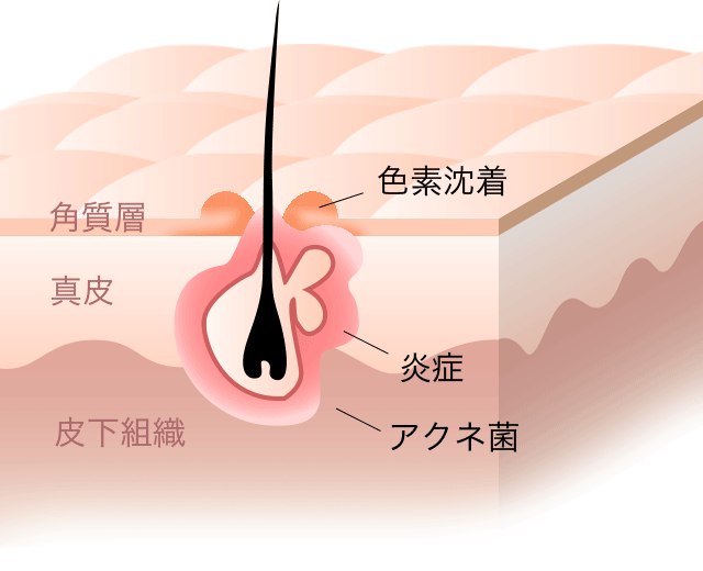 炎症が小さい状態から徐々に広がって大きくなる